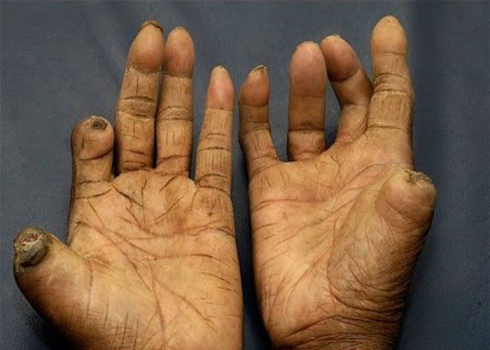 leprosy: no, it is not due to the curse of gods