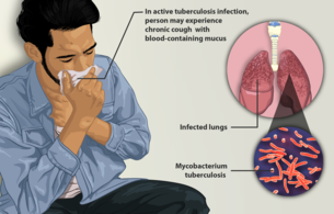 tuberculosis... till now you thought it is about coughing out blood 