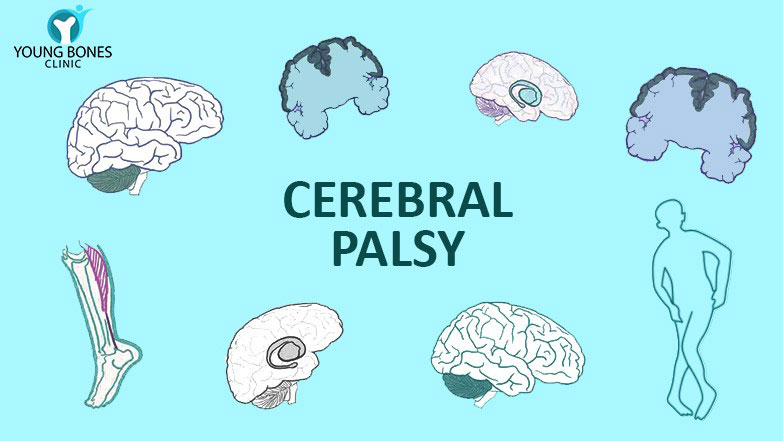 cerebral-palsy-it-is-not-a-psychiatric-disorder