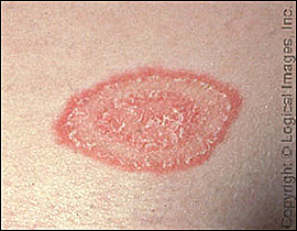 fungal infections it is not merely confined to our skin